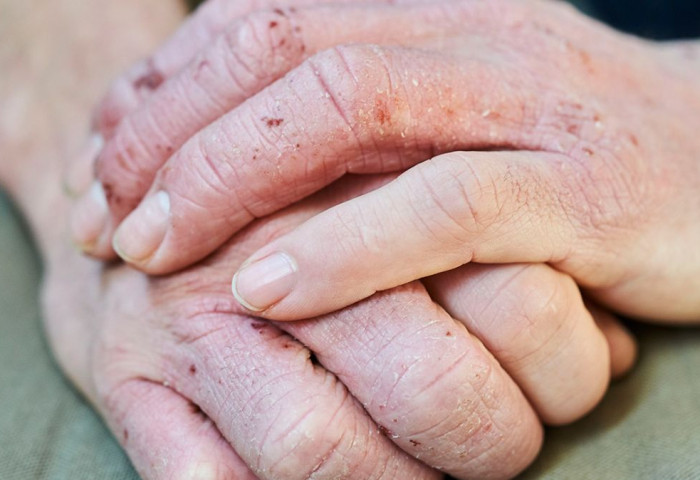 ЭМЧ: Гарын хурууны арьс хагарах буюу HAND ECZEMA