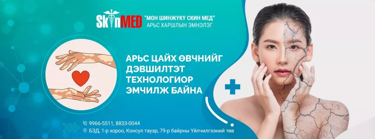 Арьс цайрах өвчний эмчилгээний төлбөрт 30-40 хувийн хөнгөлөлт зарлалаа
