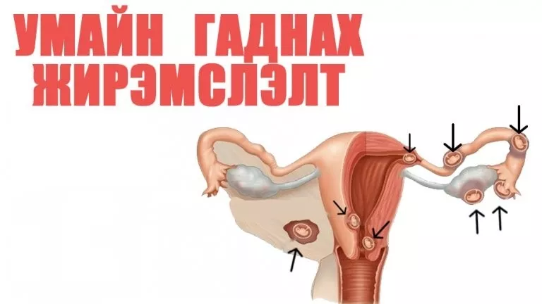 ЭМЧ: Умайн гадуурх жирэмслэлтийн талаар
