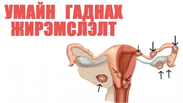 ЭМЧ: Умайн гадуурх жирэмслэлтийн талаар
