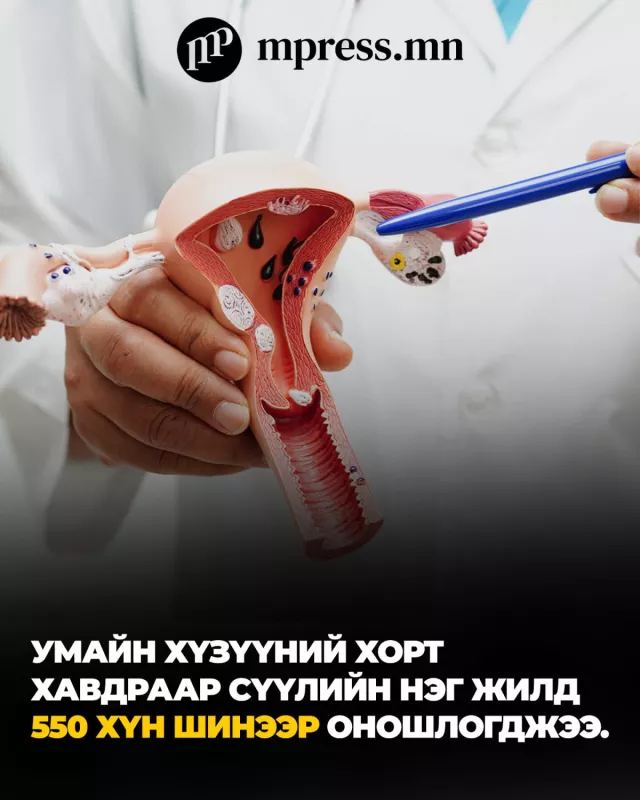 ҮСХ | Умайн хүзүүний хорт хавдраар сүүлийн нэг жилд 550 хүн шинээр оношлогджээ
