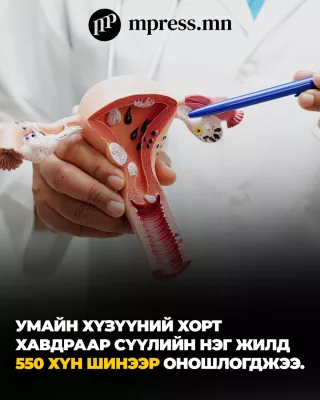 ҮСХ | Умайн хүзүүний хорт хавдраар сүүлийн нэг жилд 550 хүн шинээр оношлогджээ