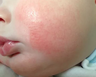 ЭМЧ: Диатез өвчний талаар мэдэх шаардлагатай бүхэн
