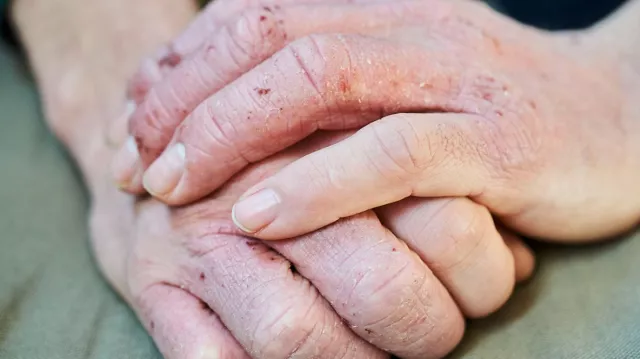 ЭМЧ: Гарын хурууны арьс хагарах буюу HAND ECZEMA