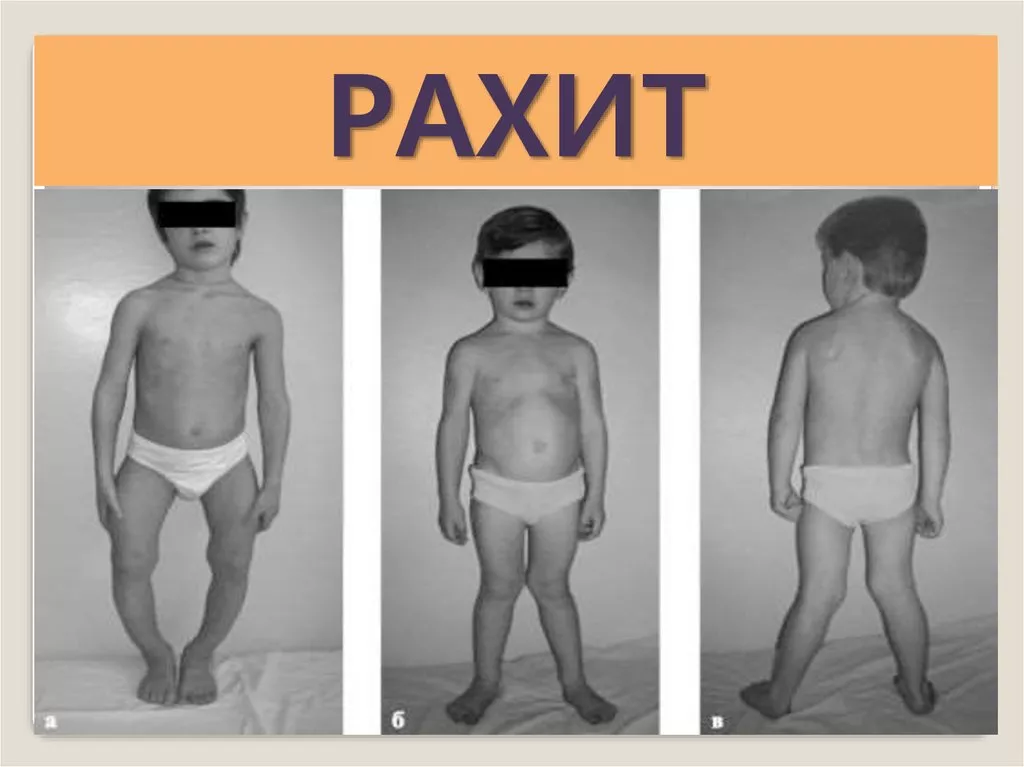 ЭМЧ: Рахит буюу сульдаа өвчин
