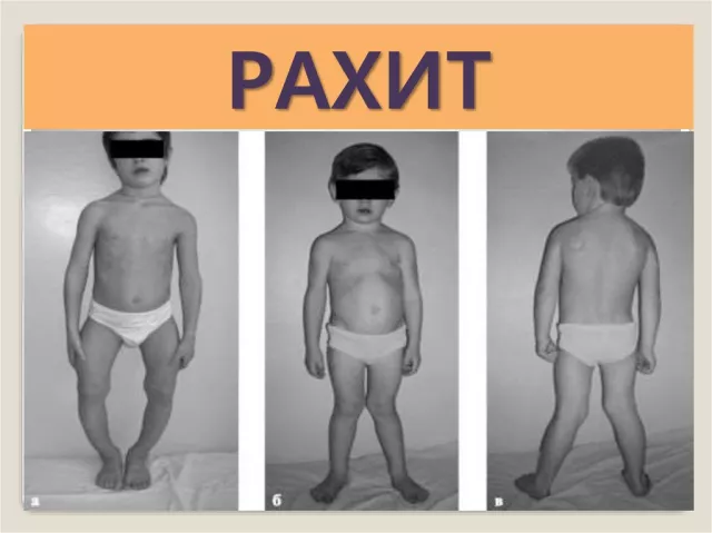 ЭМЧ: Рахит буюу сульдаа өвчин