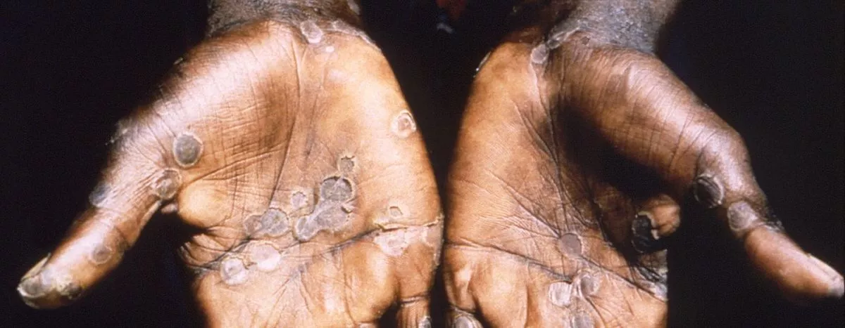 MonkeyPox буюу Сармагчны цэцэг өвчний талаарх БҮХ МЭДЭЭЛЭЛ